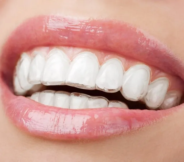 Braces