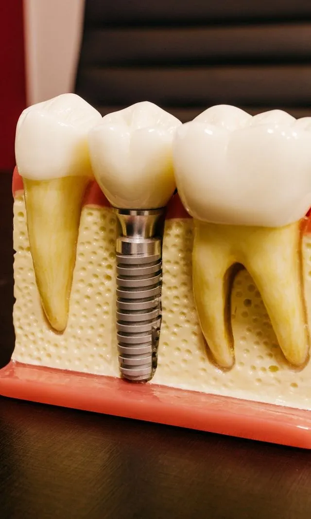 Implant model